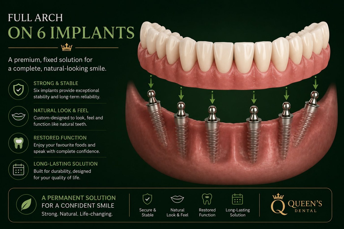 Full arch of fixed teeth supported on dental implants