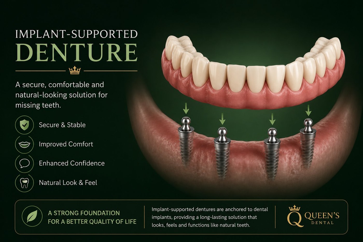 Implant-supported removable denture anchored onto implants in the jaw